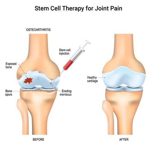 The Current Role of Stem Cells in Orthopaedic – BIOLOGY, ENVIRONMENT & MORE